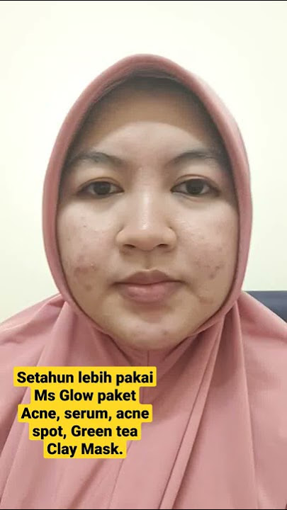 Hasil pemakaian MS Glow Acne Series Januari 2021 s/d Feb 2022