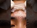 🌲 The Deepest Pore Strip Reveal Ever