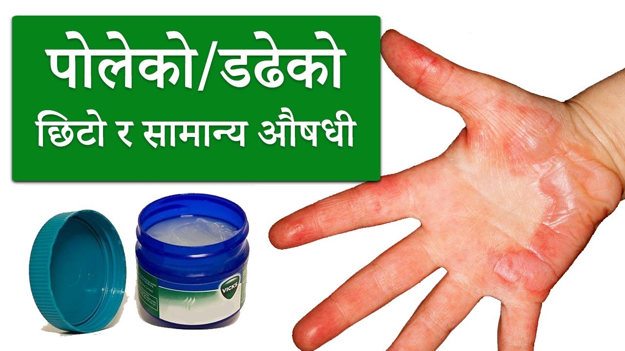 पोलेको सजिलो र सामान्य औषधी Normal Medicine for skin Burn YouTube