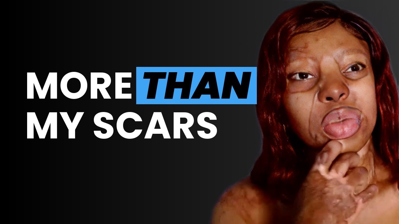 “More Than My Scars” — Kechi Okwuchi on Faith, Healing & Survival After the Sosoliso Plane Crash