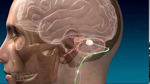 Deep Brain Stimulation for Stroke Recovery Animation - DayDayNews