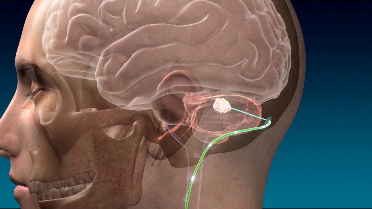 Deep brain. ДИИП брайин Стимулейшн. Stimulates the Brain РВ. Stroke Spasticity.