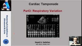 Cardiac tamponade: Part 3: Respiratory Variation
