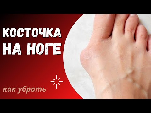 Косточка на ноге