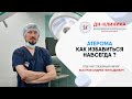 Что такое АТЕРОМА? Чем она опасна и как ее лечить? Как удаляют атеромы?