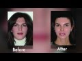 Face to Face: Transgender Facial Feminization: Plastic Surgery Hot Topics with Rod J. Rohrich, MD