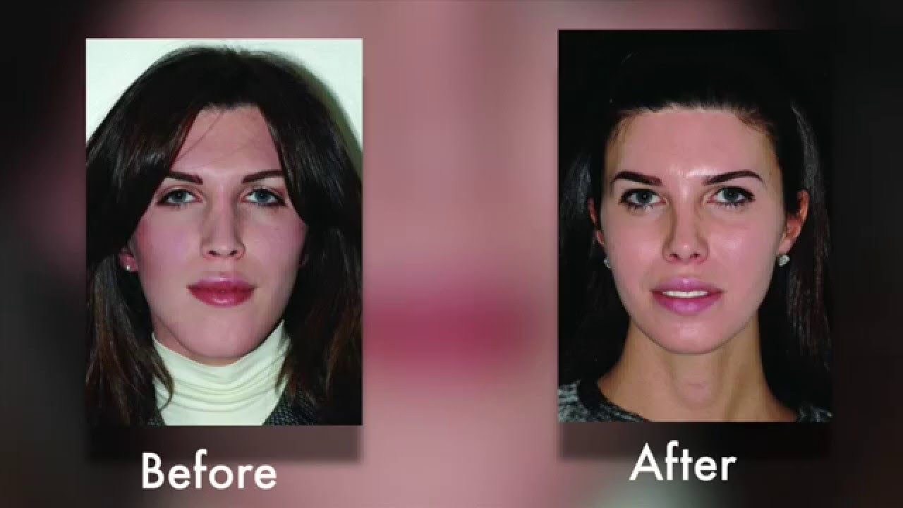 Face to Face Transgender Facial Feminization Plastic Surgery Hot Topics with Rod J photo