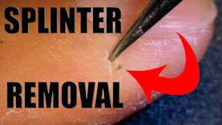 Foreign Object Removal From Finger