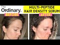THE ORDINARY MULTI-PEPTIDE SERUM FOR HAIR DENSITY REVIEW | BEFORE AND AFTER - 6 MONTH UPDATE