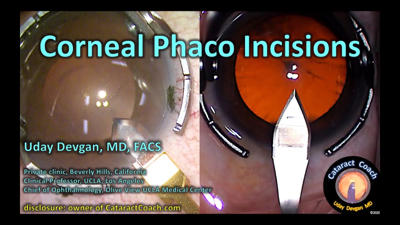 Complete Anterior Capsule Phimosis following Cataract Surgery in a Patient  with a History of Retinopathy of Prematurity, Nystagmus, and a Narrow Angle  | Semantic Scholar