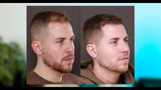 1 Year After Hair Transplant Results From UFP Hair Restoration