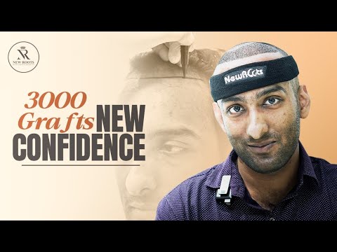 3000 Grafts Hair Transplant in Siliguri 😲 | Real Patient Experience | New Roots