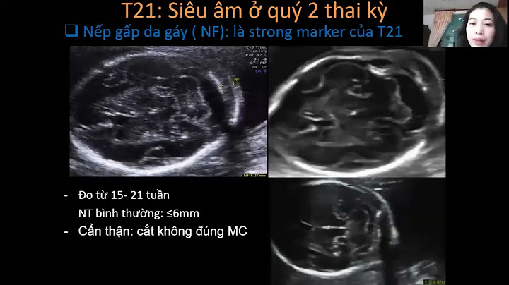 Nhiễm sắc thể 18 là gì