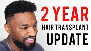 2 Year Hair Transplant Update &amp; New Hair Journey with Copenhagen Grooming!