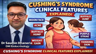 Cushing second part -clinical features