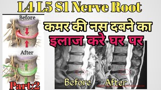 L4 L5 S1 nerve root compression exercises | buldging Disc exercises | Herniated Exercise | in hindi