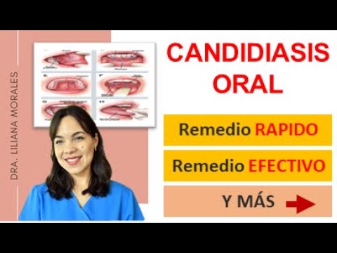 😬3 Remedios naturales para CANDIDIASIS orales/Cándida Albicans/causas-tratamiento/Episodio 61