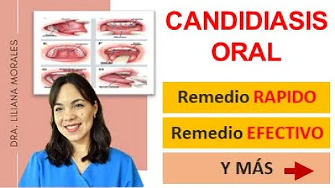 ¿Cuál es el tratamiento más eficaz para la candidiasis oral?