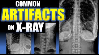 Common Artifacts on X-Ray #radiology #xray #doctor