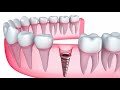 Medent dental implants