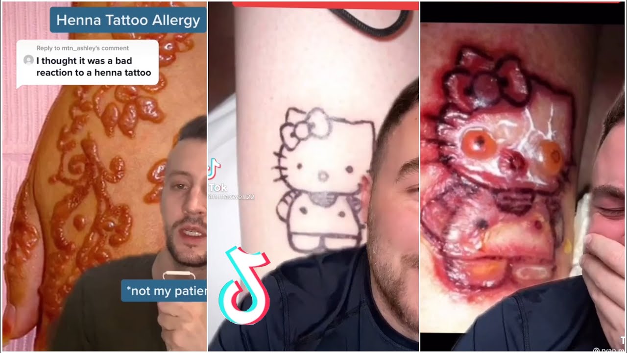 Boy suffers allergic reaction from 'black henna' tattoo - Indianapolis News  | Indiana Weather | Indiana Traffic | WISH-TV |
