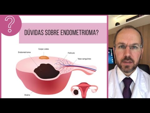 Vídeo: Cisto De Chocolate (endometrioma Ovariano): Tratamento, Fertilidade E Muito Mais