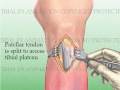 Tibial Fracture repair with Titanium Intramedullary Rod