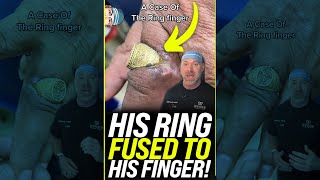 Ring Got Stuck and FUSED to His Finger?! 😱 #shorts
