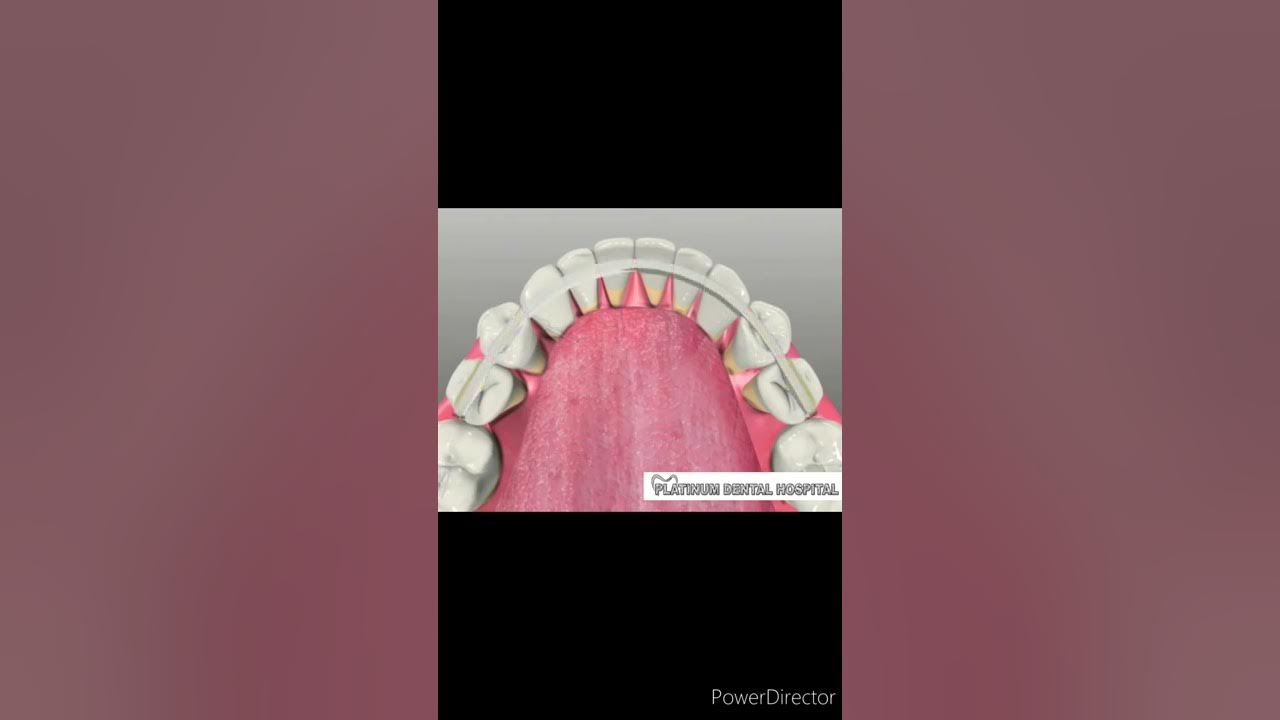 Periodontal Splint ( Stabilization of Loose Teeth ) YouTube