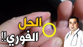 علاج فطريات القدم (تجربتي)  ||  (الحل) النهائي في (خطوتين)️