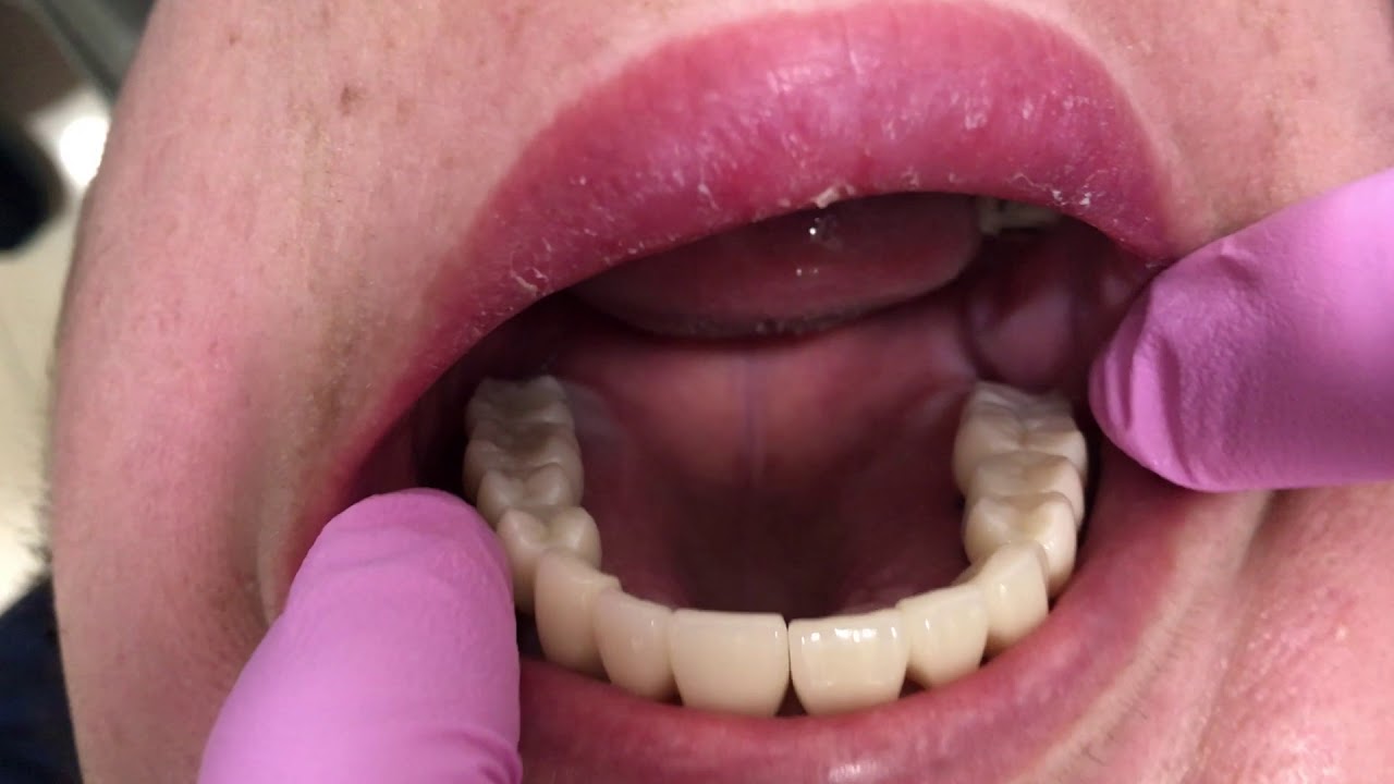 All on 8 Dental implant video 1 YouTube