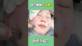 여드름 흉터에는 실펌!