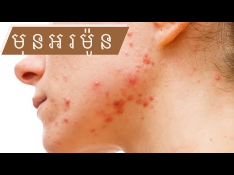 ការយល់ដឹងពីមុនអរម៉ូន | what’s hormonal acne