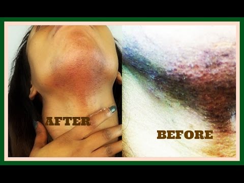 GET RID OF DARK SPOTS, ACNE SCARS &BLACK SPOTS IN  DAYS, POWERFUL NATURAL TREATMENT | Khichi Beauty