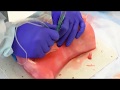 Surgical Cricothyrotomy - For Medics