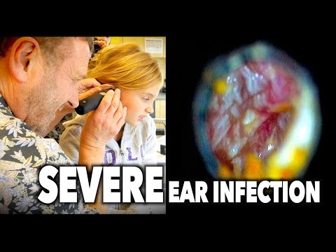 Video: Double Ear Infection: Symptomen, Behandeling En Meer