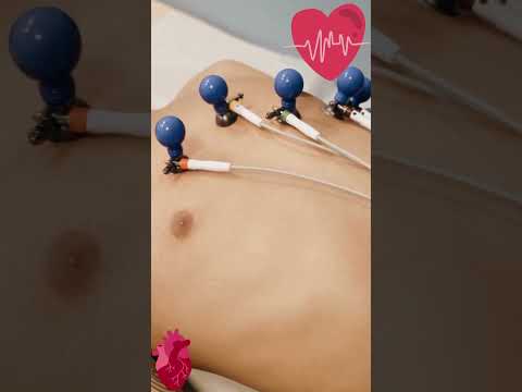 Les électrodes ECG
