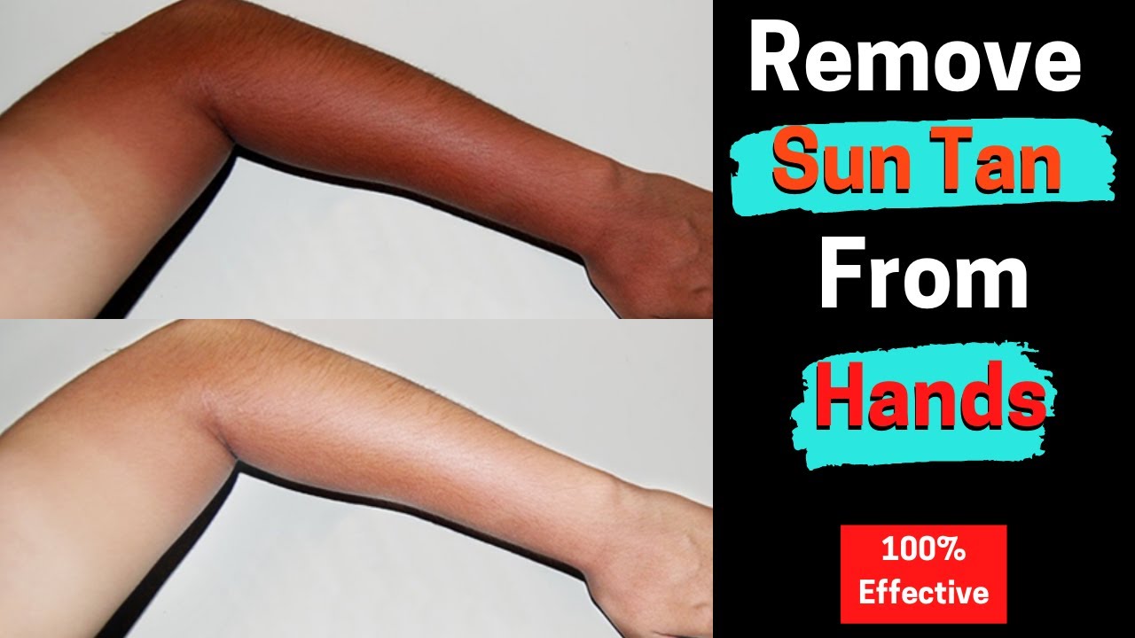 How To Remove Sun Tan From Hands Sun Tan Ko Kaise Remove Kare Sun