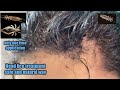 Head lice treatment safe and natural way/kuto removal/home remedy /remove head lice in a single day