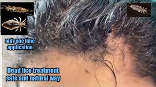 Head lice treatment safe and natural way\/kuto removal\/home remedy \/remove head lice in a single day