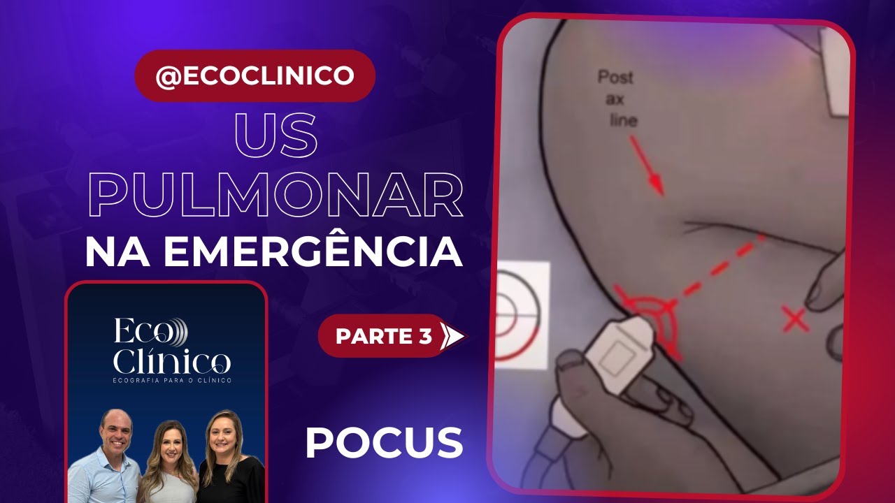Ultrassom ou Eco Pulmonar na Emergência ou UTI - POCUS - Passo a passo Parte 3 - Protocolo BLUE