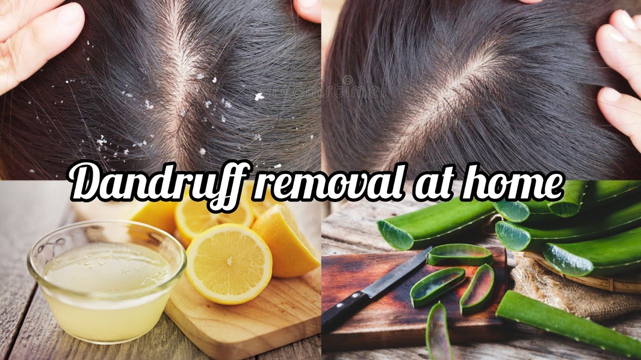 Dandruff removal at home / How to remove dandruff from hair at home