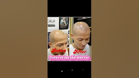 Xăm chân tóc khắc phục hói đầu #cấytóc #hóiđầu #smp #xamchantoc