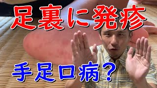 手足口病とは 赤ちゃんや子供 大人も注意 保育園は 初期症状は口内炎やかゆみ 写真有 のぶ沖縄情報チャンネルブログ