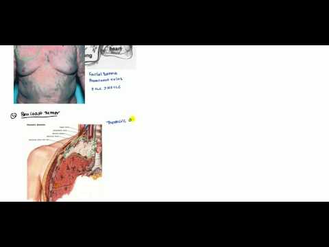 Video: Squamous Cell Lung Carcinoma: Perawatan, Pementasan, Gejala