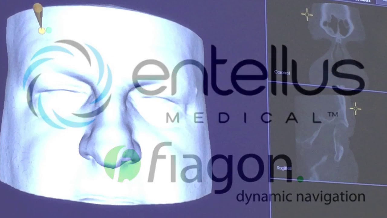 In office sinus navigation