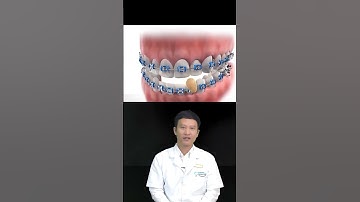 Niềng Răng Nên Hoặc Không Nên Ăn Gì?  | Nha Khoa Minh Châu