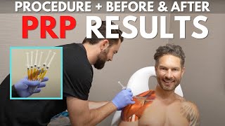 Platelet-Rich Plasma PRP Injections - Shoulder Impingement Rotator Cuff Injury Treatment Results