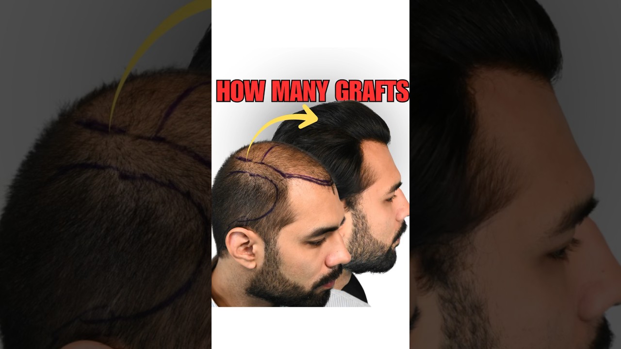 How Many Grafts Do YOU Think This Took? 👀 Dr. Emil George