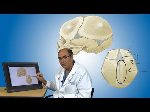 Video: Craniostenosis - ārstēšana, Craniostenosis Jaundzimušajiem